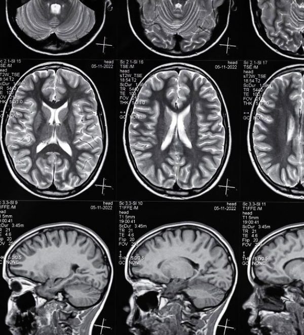 Traumatic Brain Injury